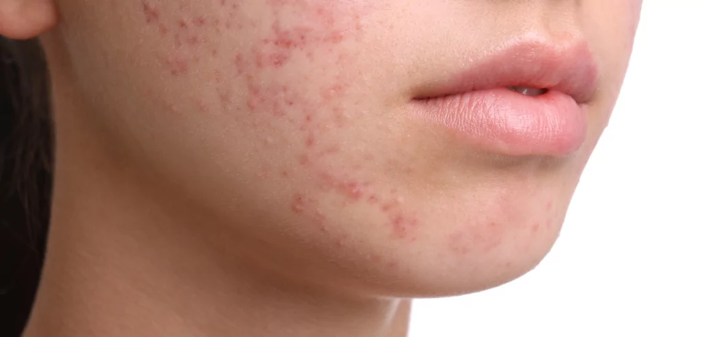 bdr-beautyblog-acne-treatment-causes